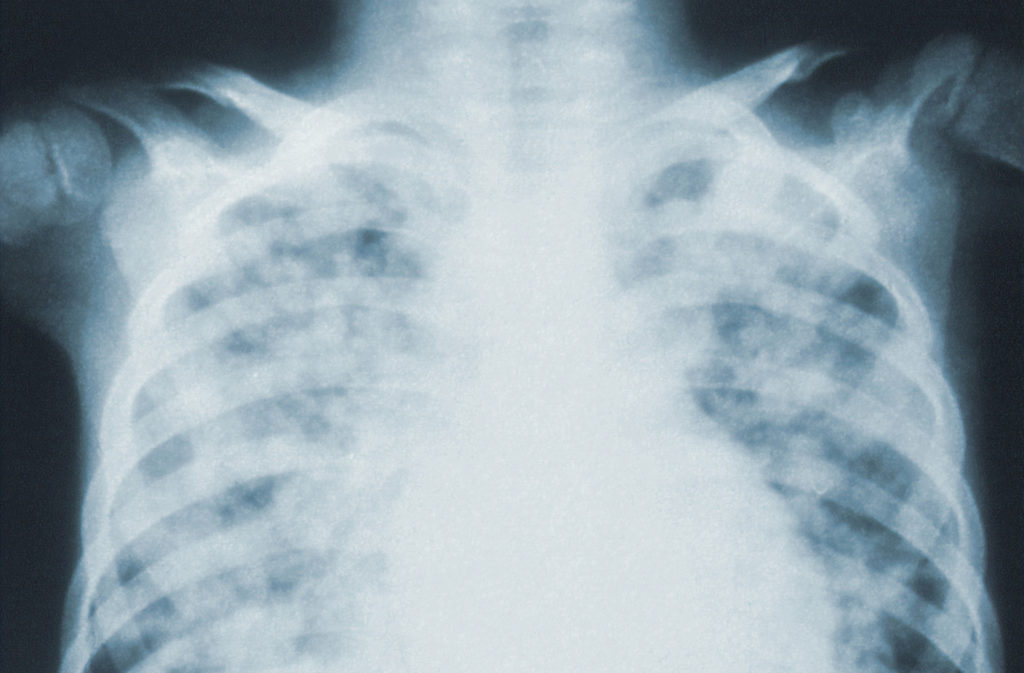 An x-ray of a human torso showing pneumonia